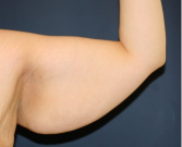 Feel Beautiful - Arm Reduction 204 - Before Photo